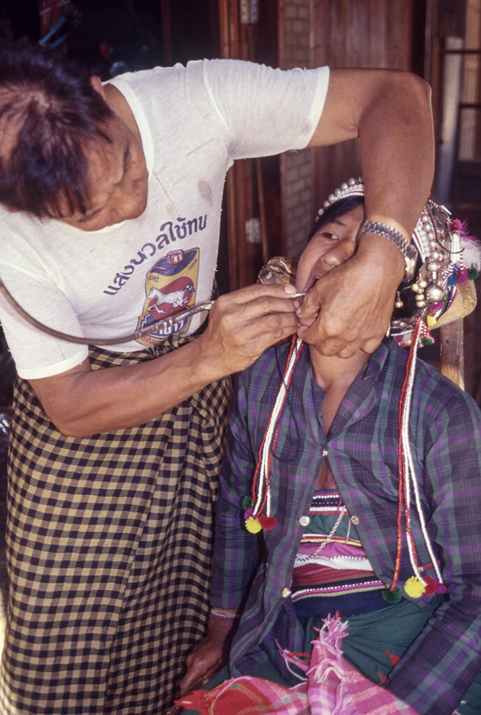 Young Akha woman being operated on by a street dentist. 